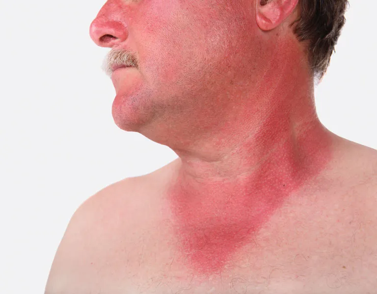 بیماری پوستی آفتاب سوختگی