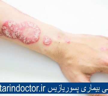 بیماری پوستی پسوریازیس