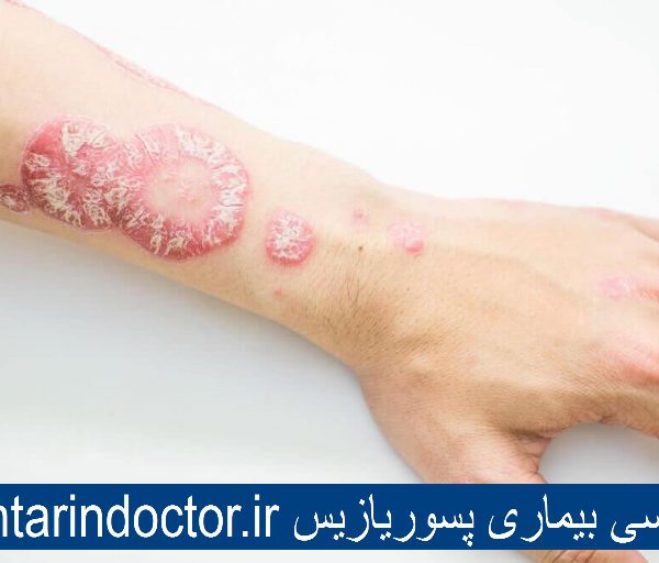 بیماری پوستی پسوریازیس