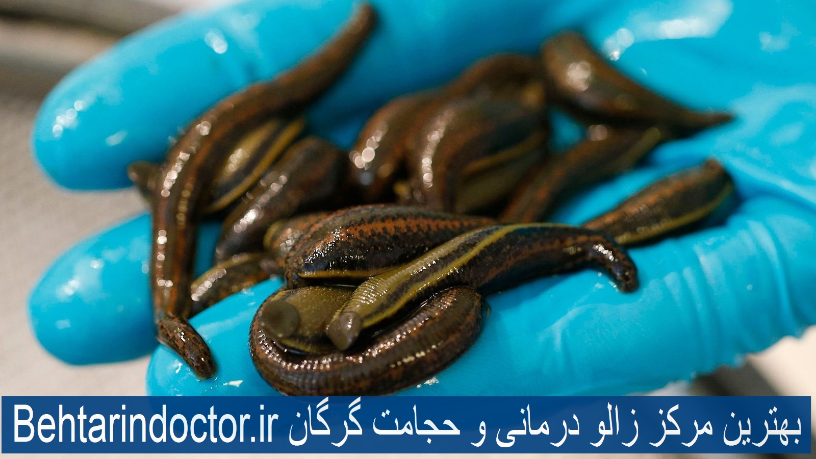بهترین مرکز زالو درمانی و حجامت گرگان
