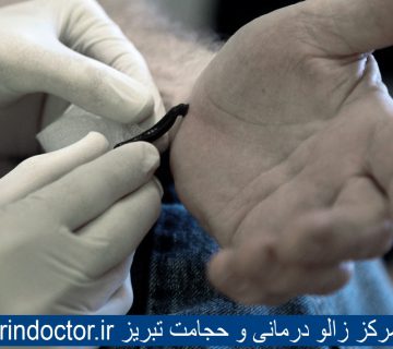 بهترین مرکز زالو درمانی و حجامت تبریز