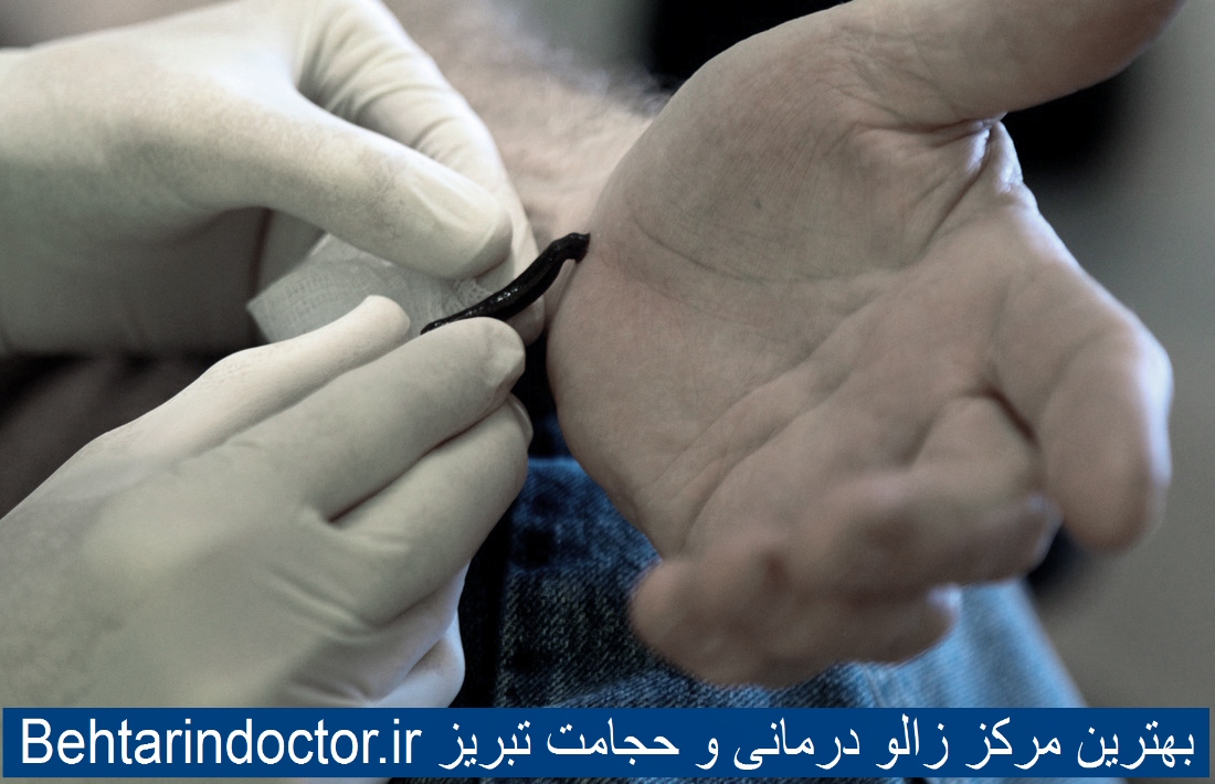 بهترین مرکز زالو درمانی و حجامت تبریز
