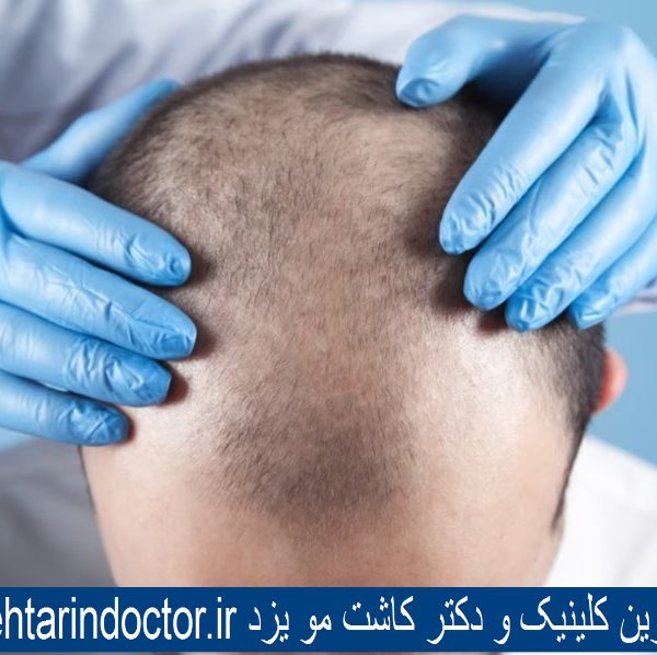 بهترین کلینیک و دکتر کاشت مو یزد