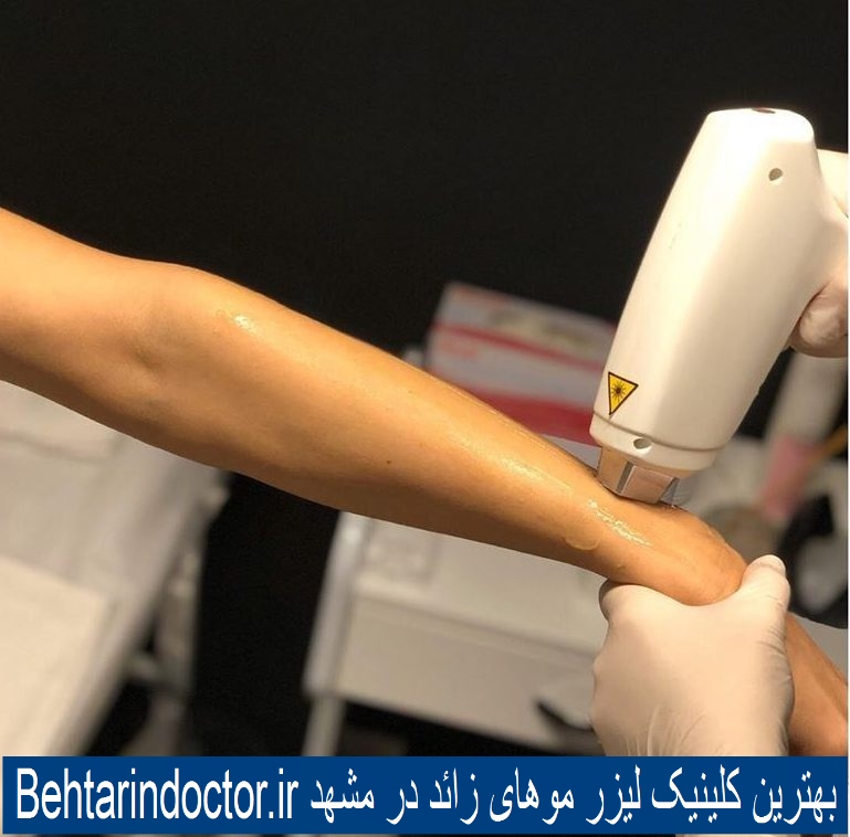لیزر موهای زائد بدن - بهترین کلینیک زیبایی در مشهد