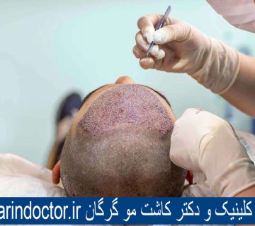 بهترین کلینیک و دکتر کاشت مو گرگان