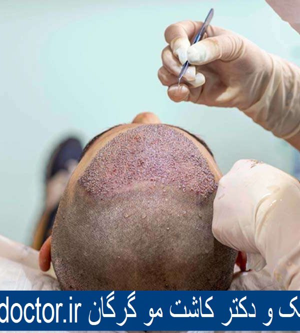 بهترین کلینیک و دکتر کاشت مو گرگان