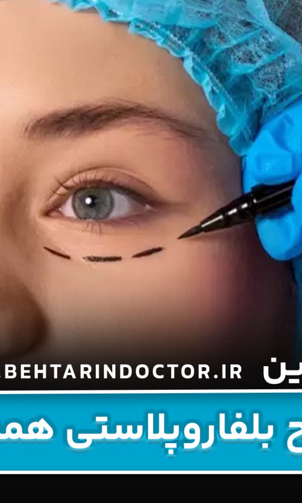بهترین دکتر جراح بلفاروپلاستی همدان