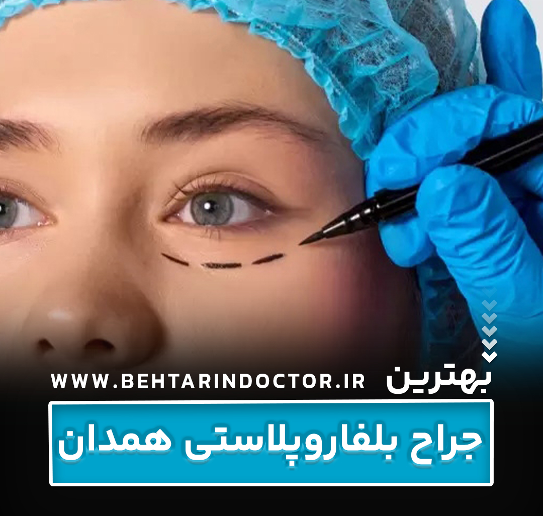 بهترین دکتر جراح بلفاروپلاستی همدان