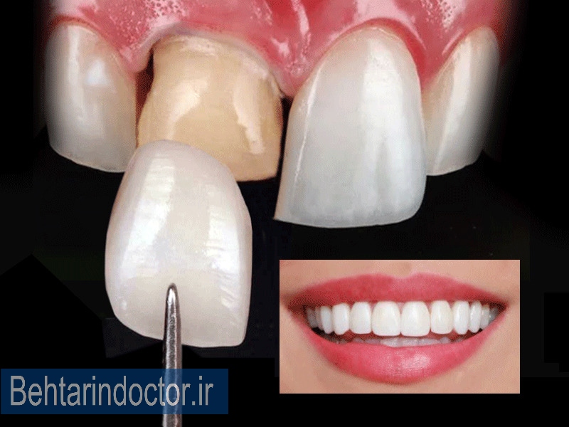 دکتر لمینت و کامپوزیت دندان 