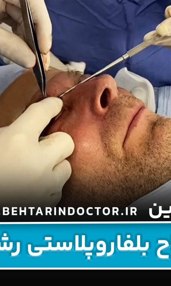 بهترین دکتر جراح بلفاروپلاستی رشت