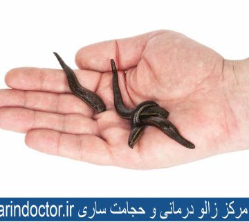 بهترین مرکز زالو درمانی و حجامت ساری