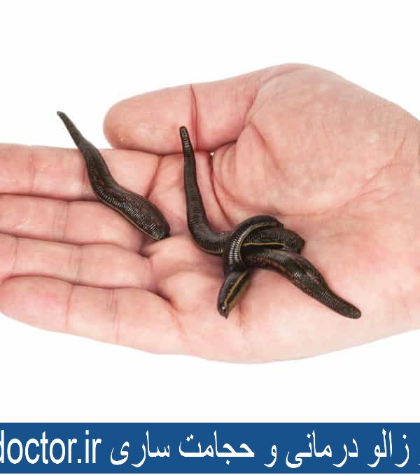 بهترین مرکز زالو درمانی و حجامت ساری