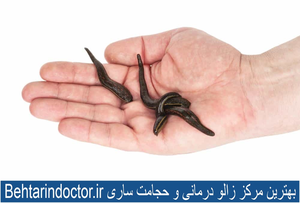 بهترین مرکز زالو درمانی و حجامت ساری