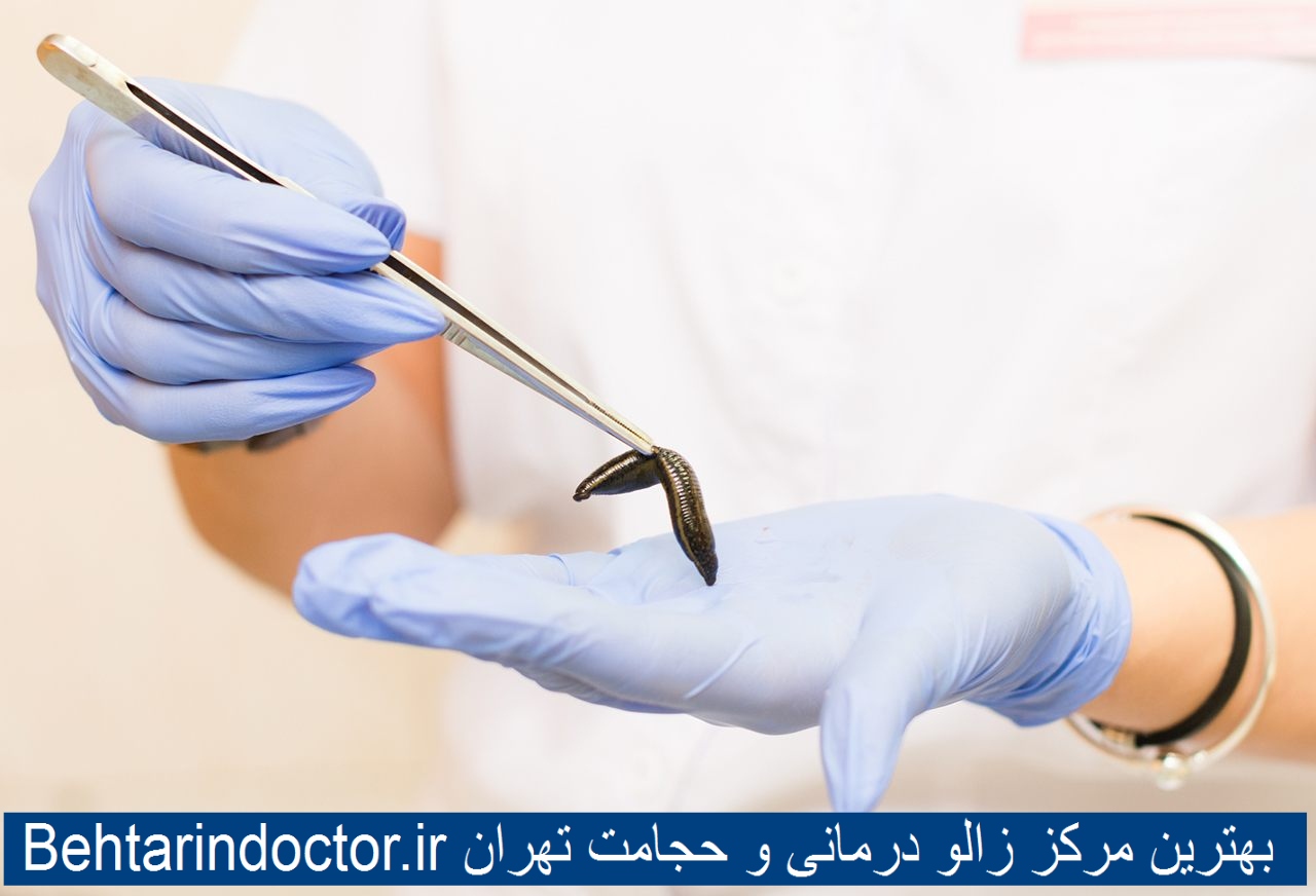 بهترین مرکز زالو درمانی و حجامت تهران