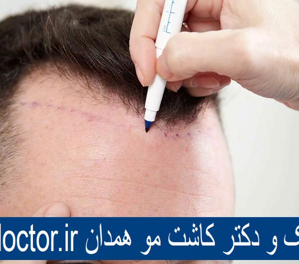 بهترین کلینیک و دکتر کاشت مو همدان