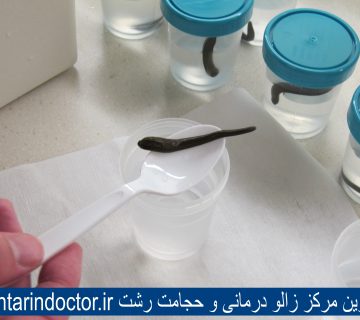 بهترین مرکز زالو درمانی و حجامت رشت