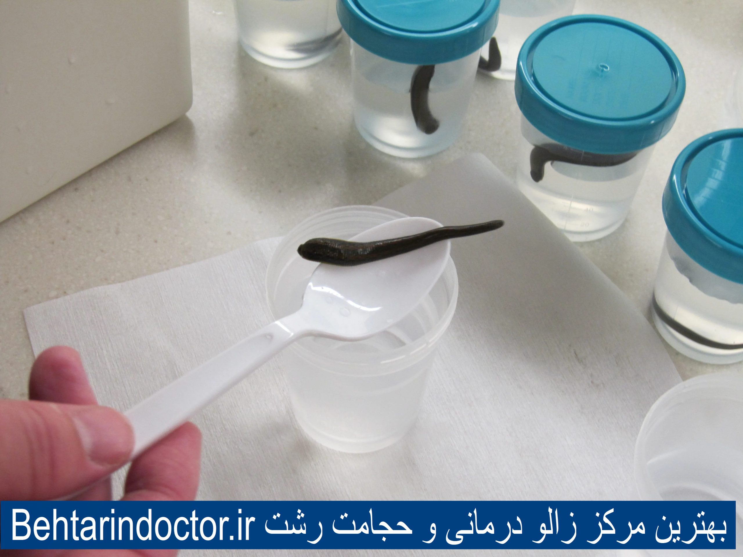 بهترین مرکز زالو درمانی و حجامت رشت