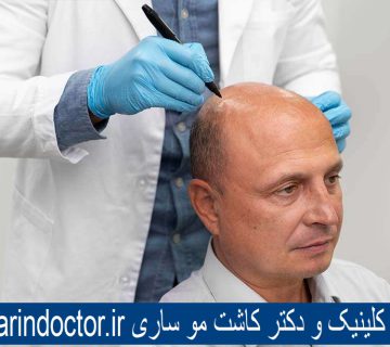 بهترین کلینیک و دکتر کاشت مو ساری