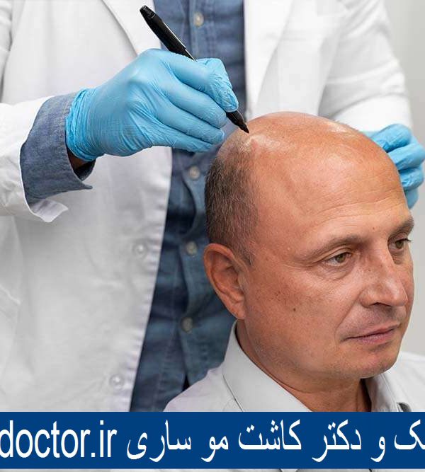 بهترین کلینیک و دکتر کاشت مو ساری