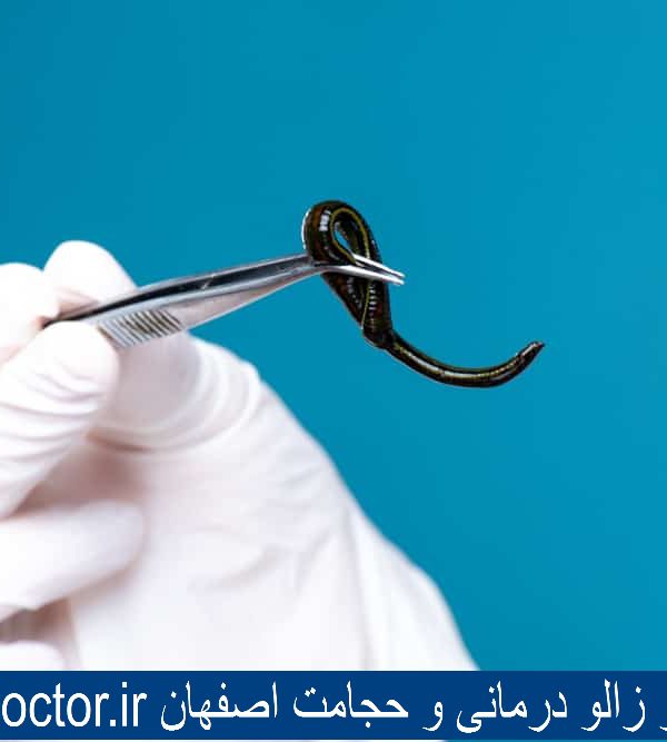 بهترین مرکز زالو درمانی و حجامت اصفهان