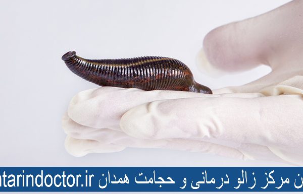 بهترین مرکز زالو درمانی و حجامت همدان