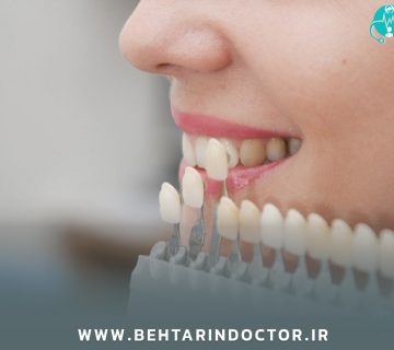 راهنمای کامل لمینت دندان : اطلاعات، فواید و روند اجرا