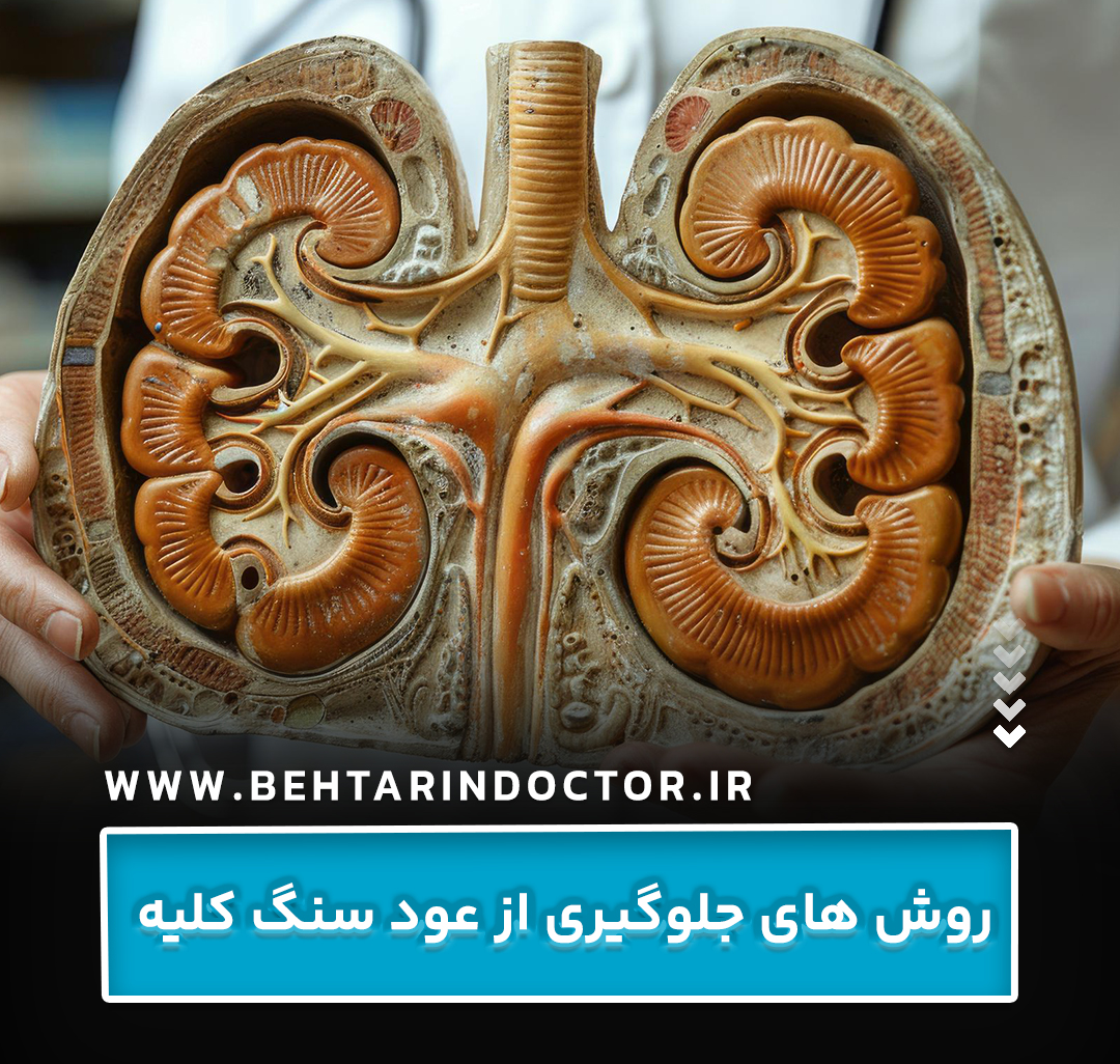 روش‌ های جلوگیری از عود سنگ کلیه